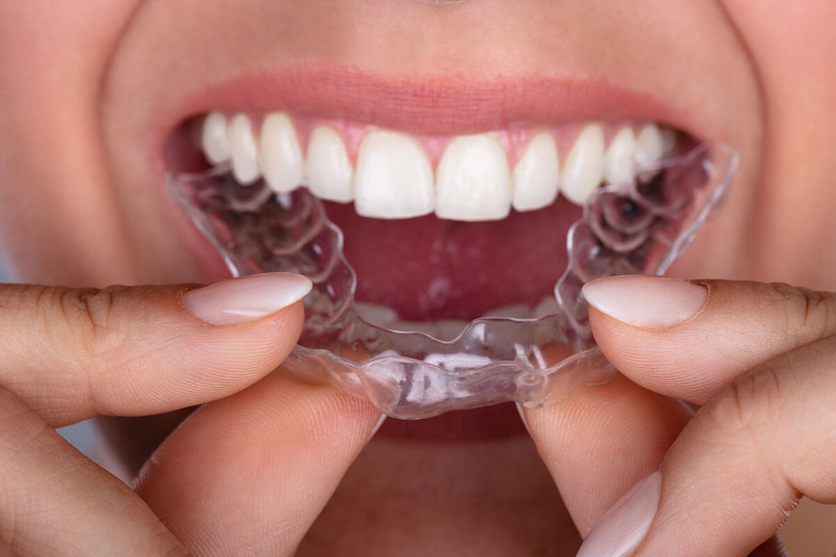 4 Benefits of Sure Smile Over Traditional Braces